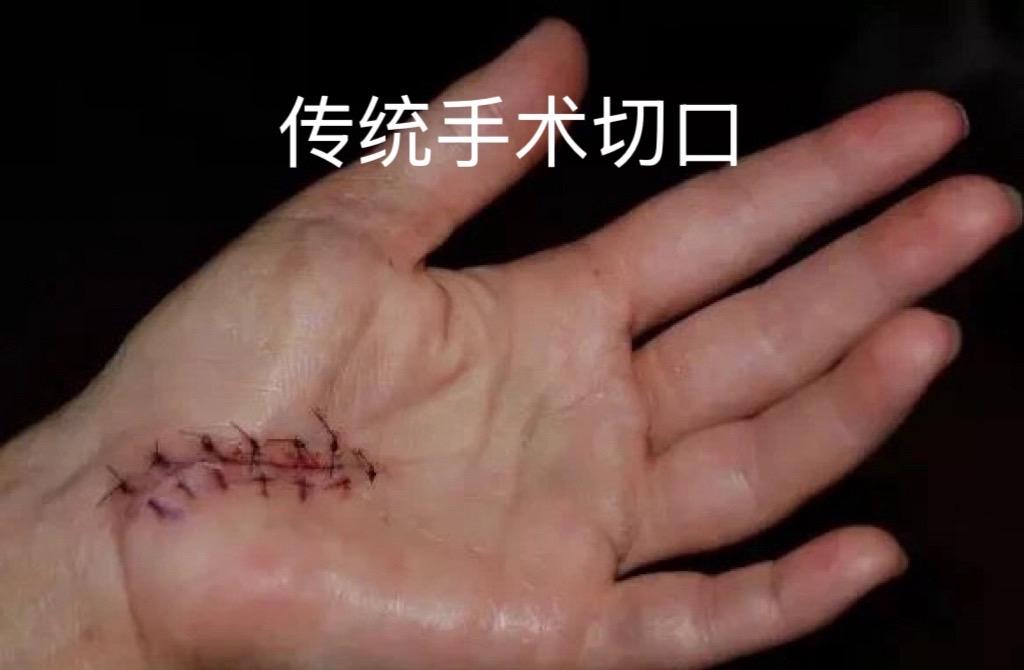 今日新花活-腕管综合征的镜下松解。腕管综合征的关节镜松解