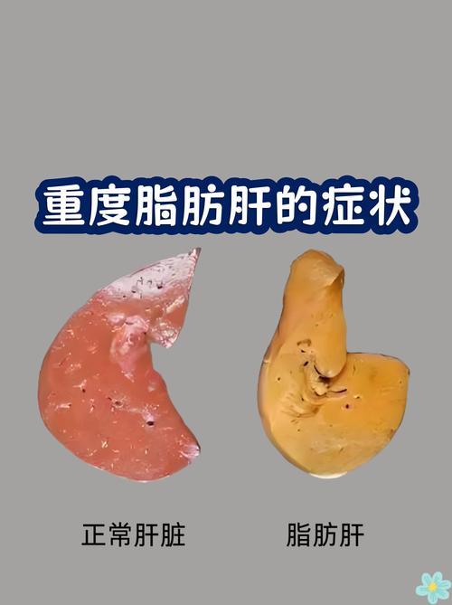 人到中年之后，各项身体机能慢慢下降，肝脏问题变得越来越普遍。很多人长期久坐，三餐