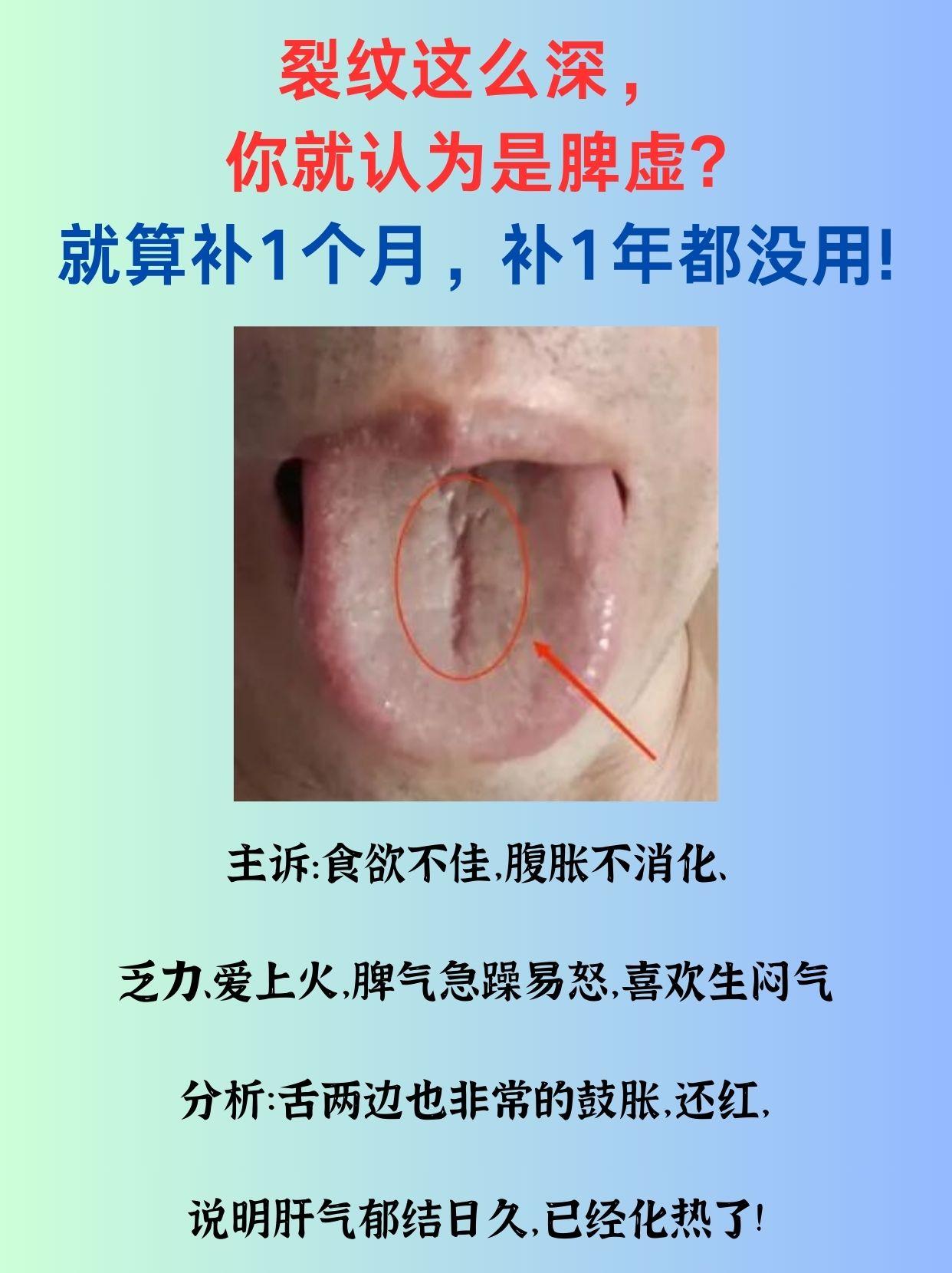 裂纹这么深 你就认为是脾虚吗？