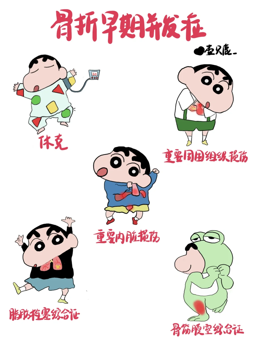 医学生笔记📒｜骨折早期并发症🧐