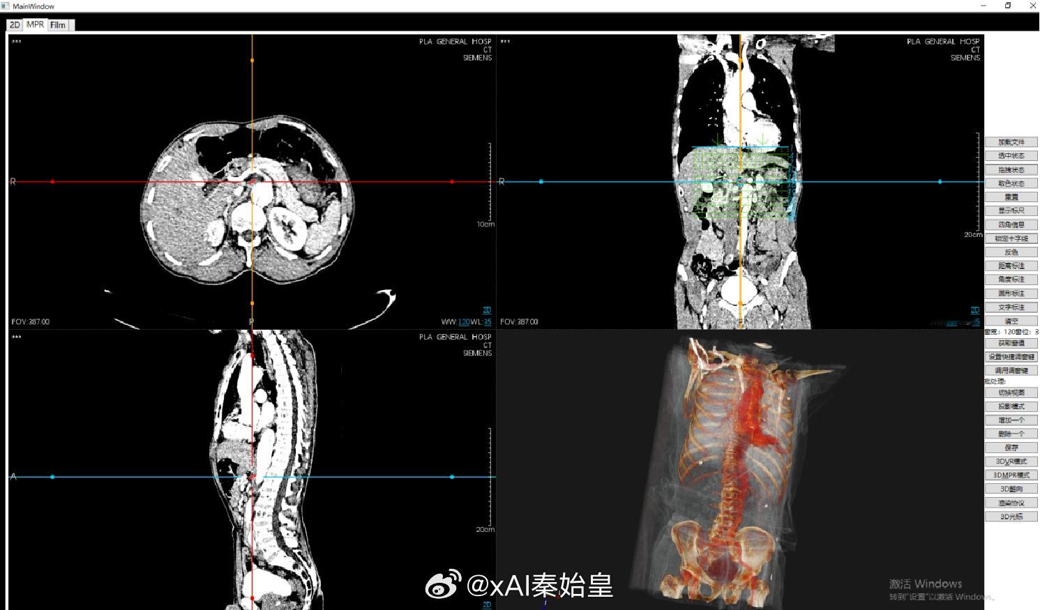 码农的日常 目前给CBCT 的OC做  三维重建，是嵌入在MPR的，MPR有vt
