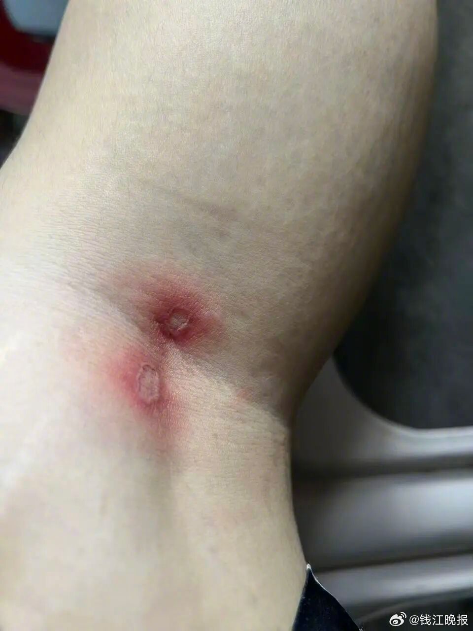 【#小伙睡觉虫子进内裤隐私部位糜烂#】二十多岁的年轻小伙小陈夜里没关窗，隐翅虫钻