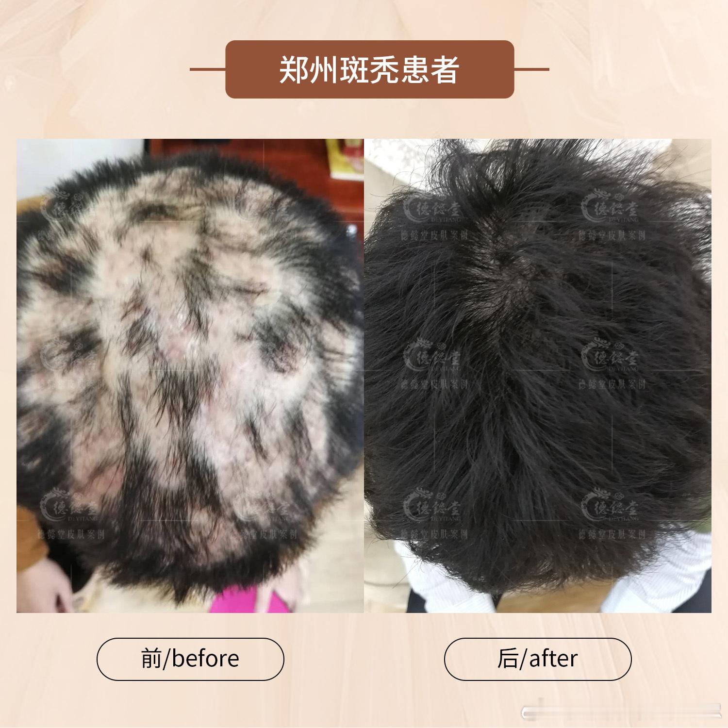 斑秃  斑秃灵方组成：补骨脂50g，当归20g，桂枝15g，生姜30g。功效：补
