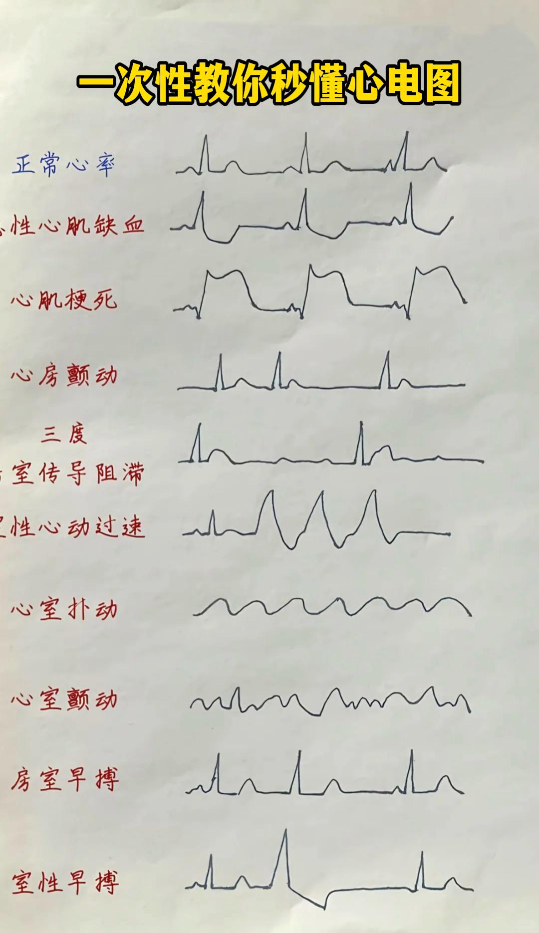 一次性教你看懂心电图！你属于哪一种？