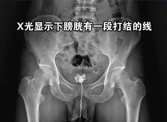 吃到一个大瓜。有个28岁的小伙子，为了寻求刺激，居然把一条25厘米长的数据线塞进