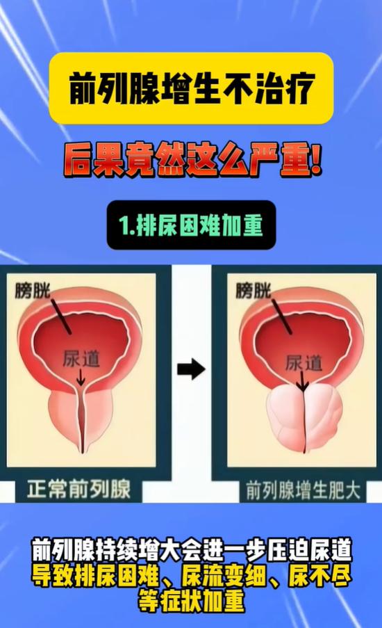 前列腺增生放任不管，5 个危害一步步找上门