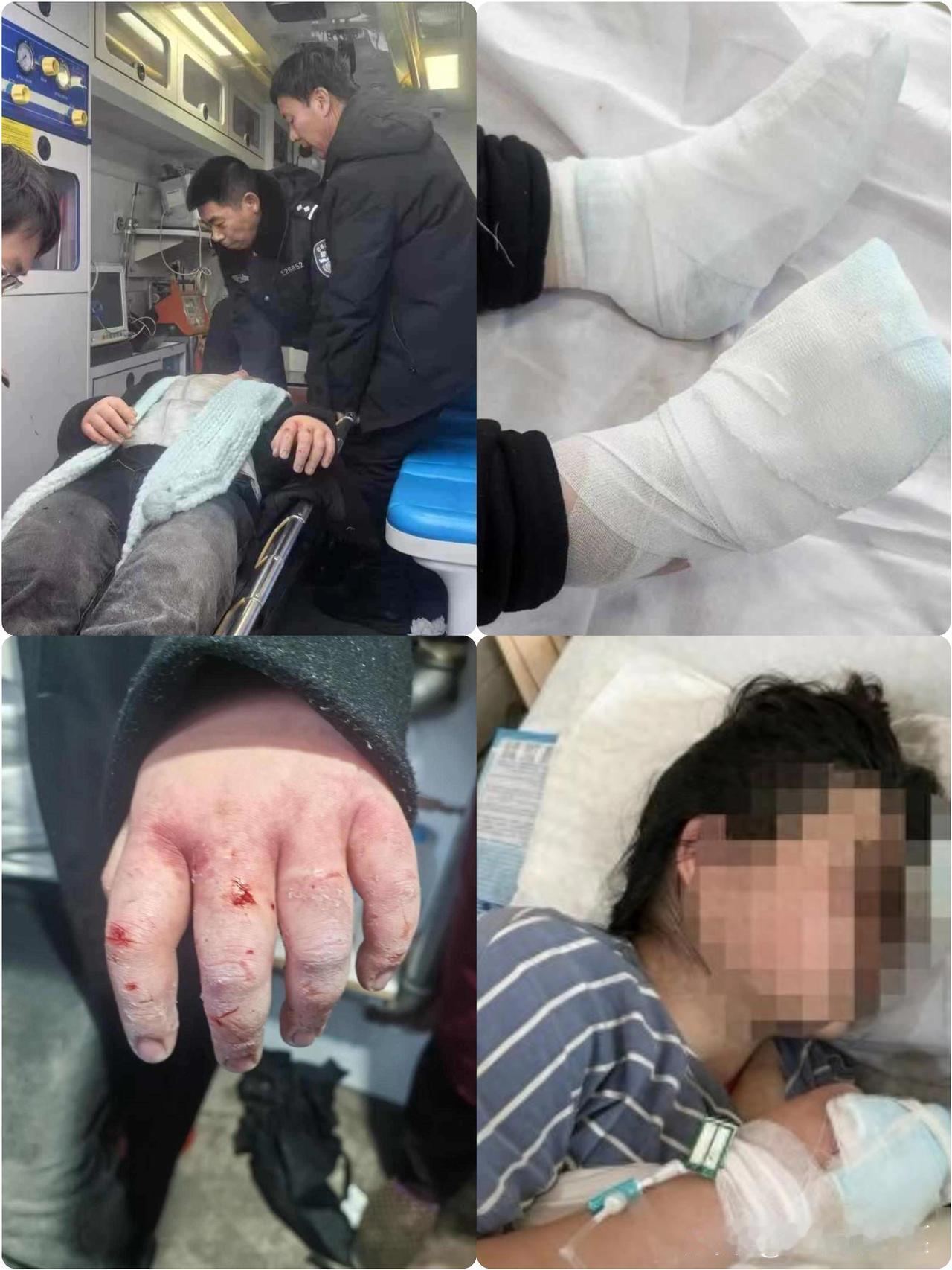 四川女大学生到东北游玩晕倒雪地冻伤，
左手三根手指或面临截肢！
2300余名爱心