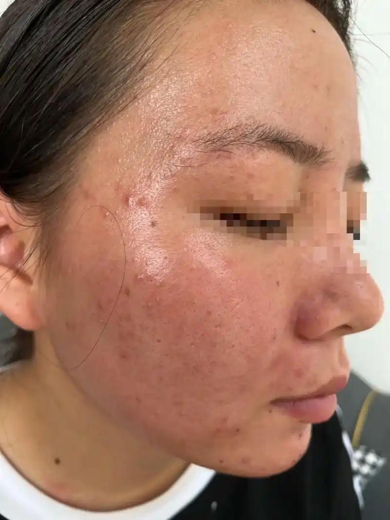 你可能想不到，脸上长痘并不只是因为没洗干净脸，很多时候其实是太阳“烤”出来的。