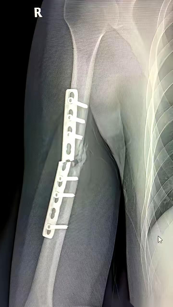 打进骨头的钢板断了，究竟是质量太差，还是用力过猛。
以前总觉得打进骨头的钢板不会