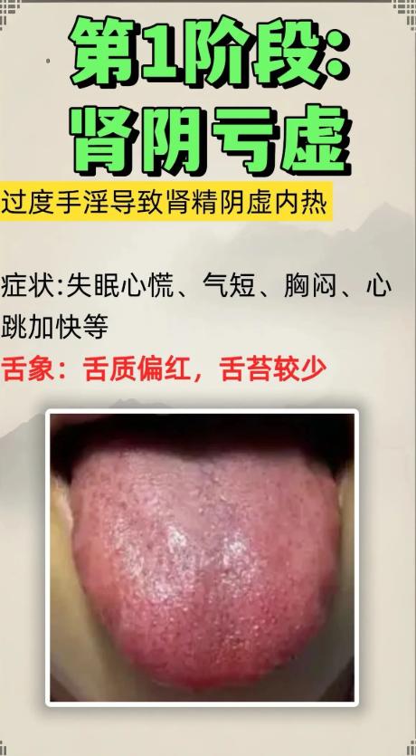 肾虚的 4 个进阶阶段，对照舌象，一目了然