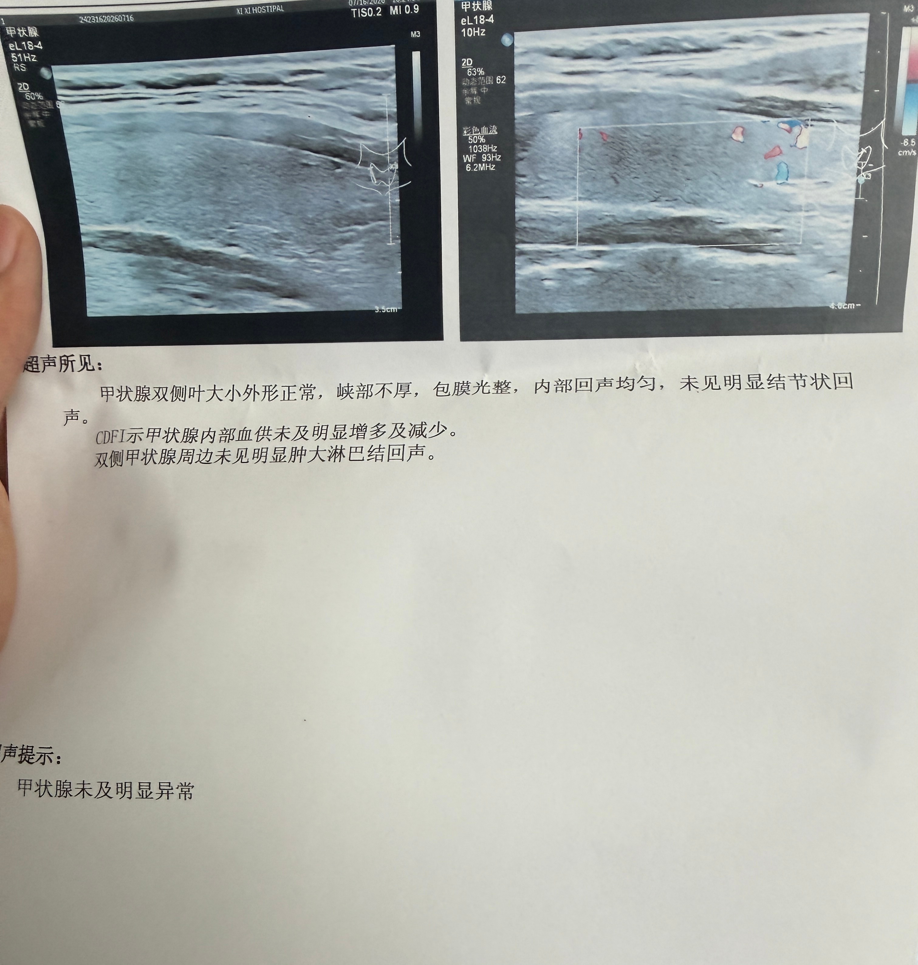 之前打替尔其实都没拍过甲状腺彩超，后面听朋友说的有点怕怕的就没打了今天去检查了一