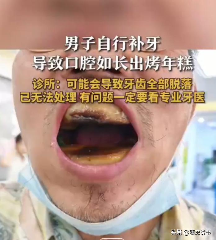 天津大叔5元网购材料自行补牙，口腔糊成“烤年糕”难处理

省钱千万别拿健康赌，天