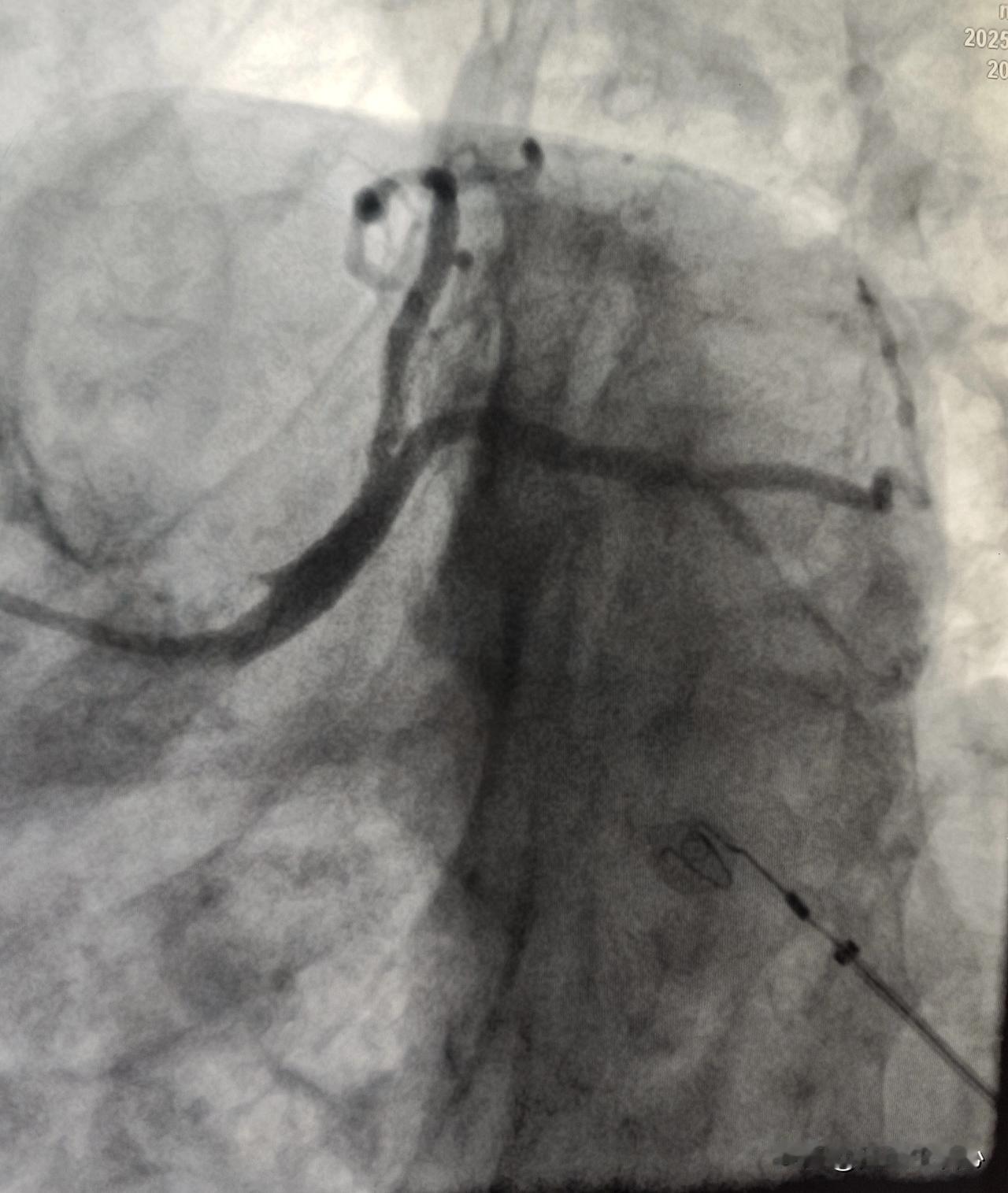 晚上九点结束了一天的工作。今天做了3台冠脉支架手术和3台起搏器手术。
其中一台冠