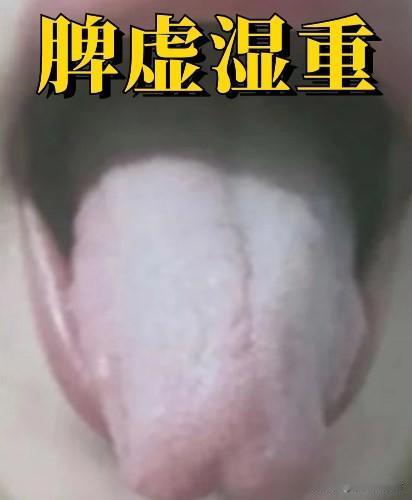 常见的5种舌象，中医教你如何调理
1.脾虚湿重
舌象：舌体胖大、舌边有齿痕，舌苔
