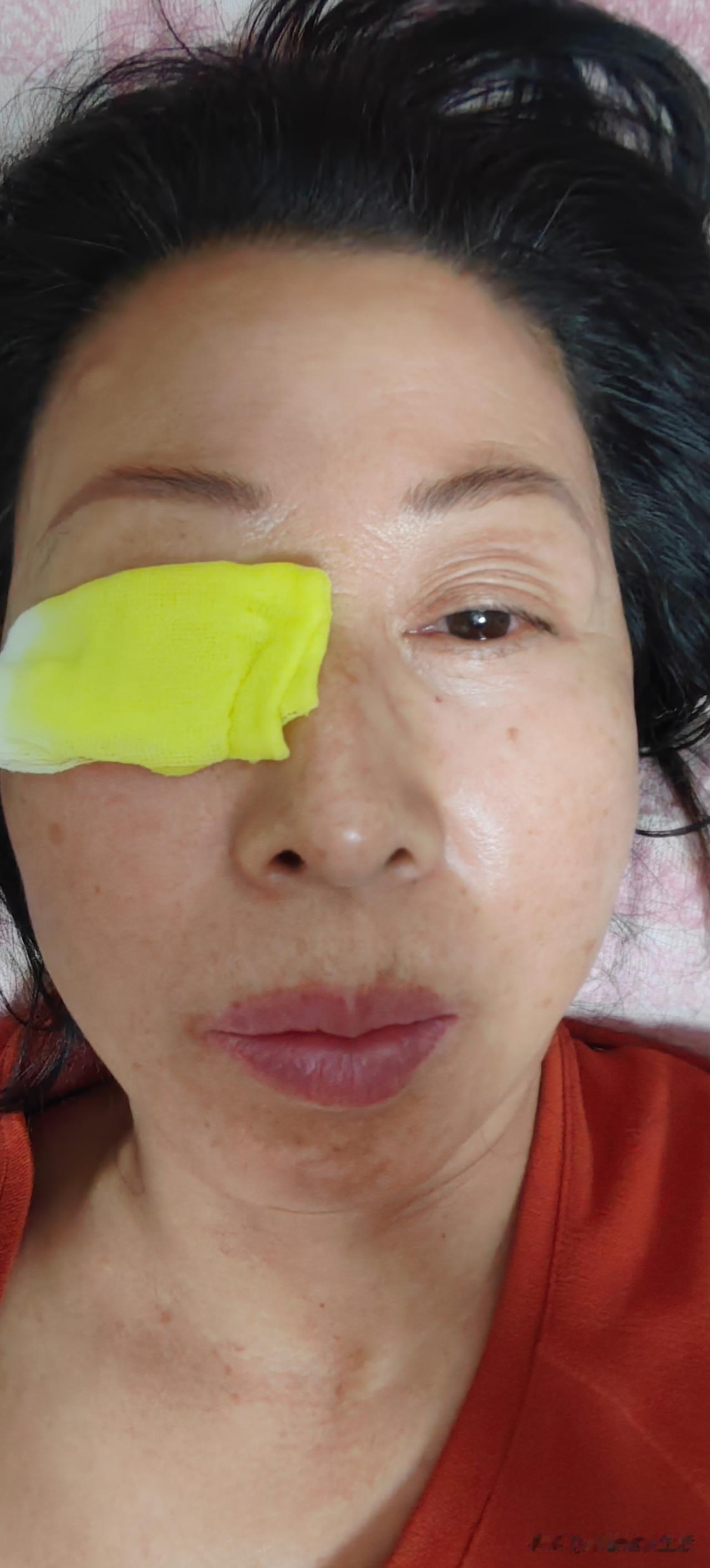 麦粒肿第四天了，第一天疼，磨的疼，然后左氧氟沙星滴眼液和红霉素眼膏交替用，不见好