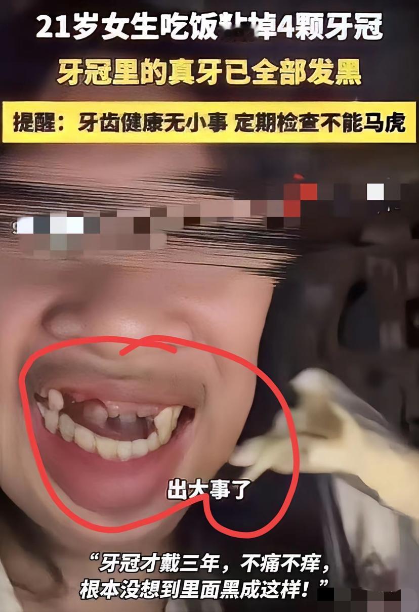 出大事了

​福建一个21岁的小姑娘
​吃饭的时候嘴里的牙冠一下掉了4个
​并且