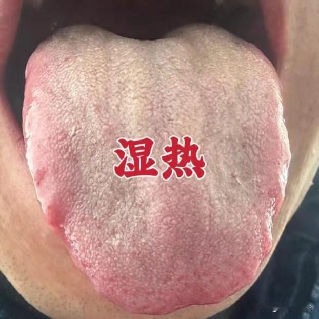今日舌诊分析：
1、“心火旺”——舌尖红，有红色斑点
2、“肝气郁结，有肝火”—
