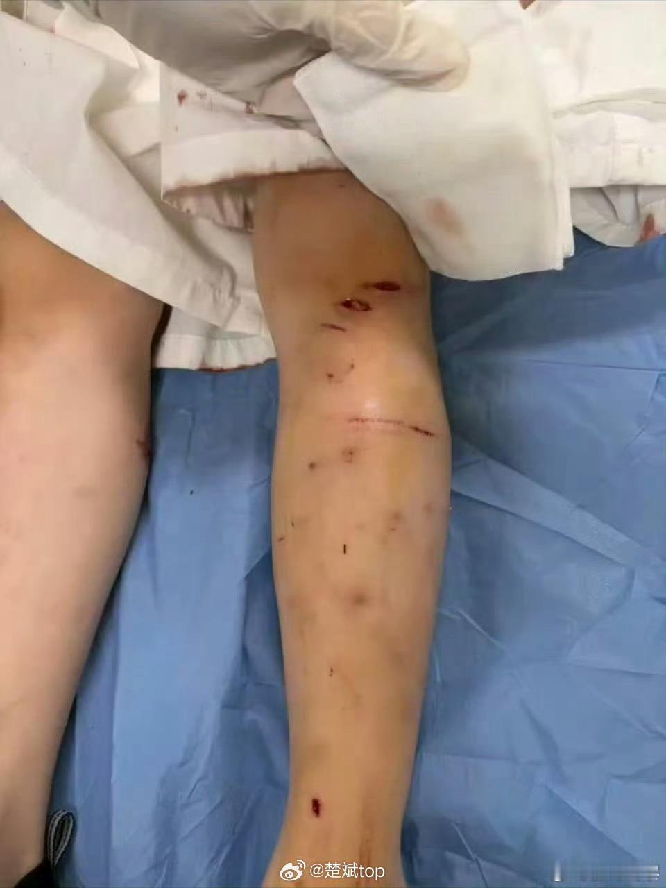 苏州遛狗不拴绳咬伤两名幼童视频发布者（小区业主）称，涉事犬只不是第一次咬人。狗抓
