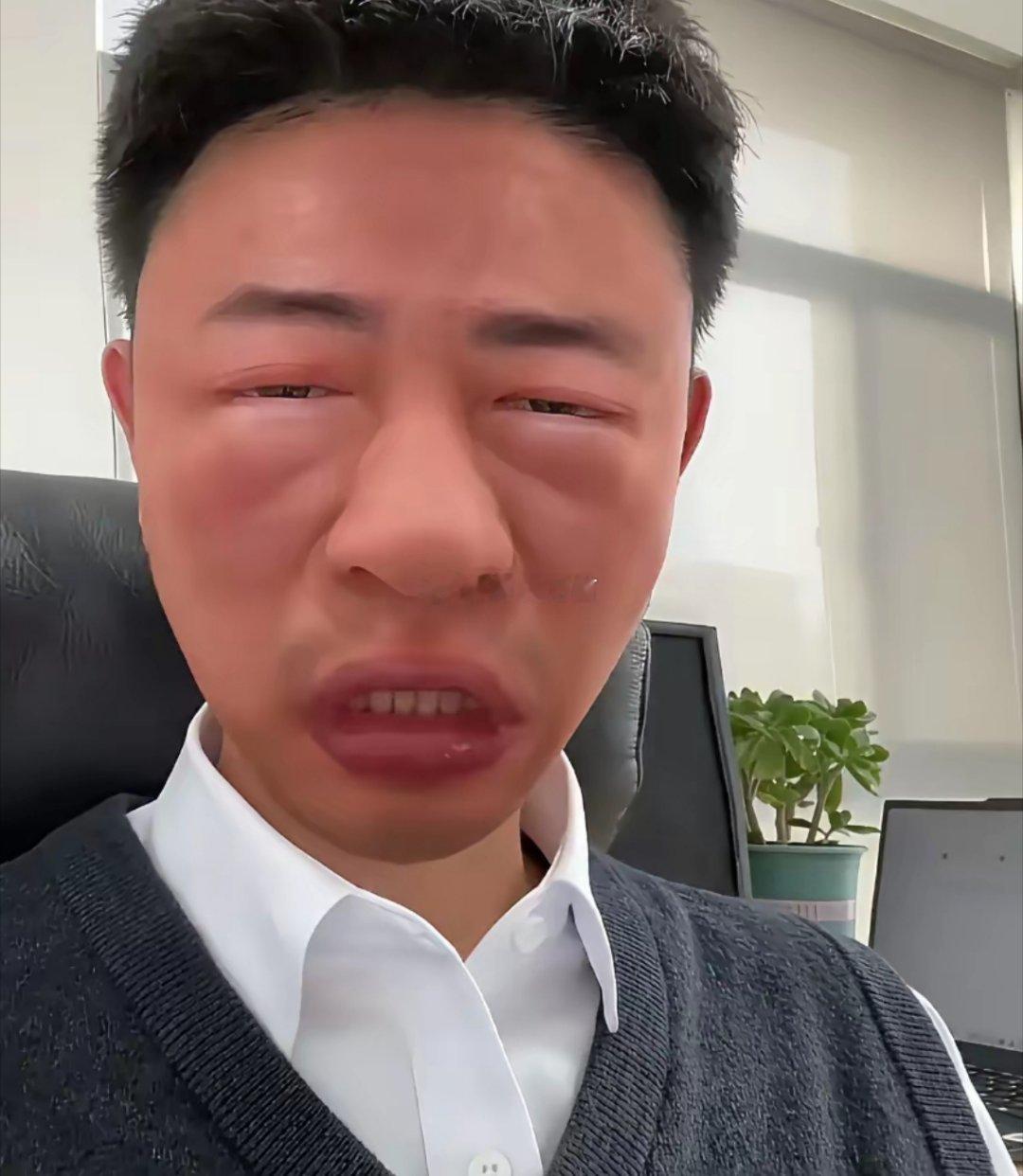 碰到不熟食材敢下嘴？漆树芽当香椿，吃完脸肿成马蜂窝。不用打码，谁也认不出你是谁。