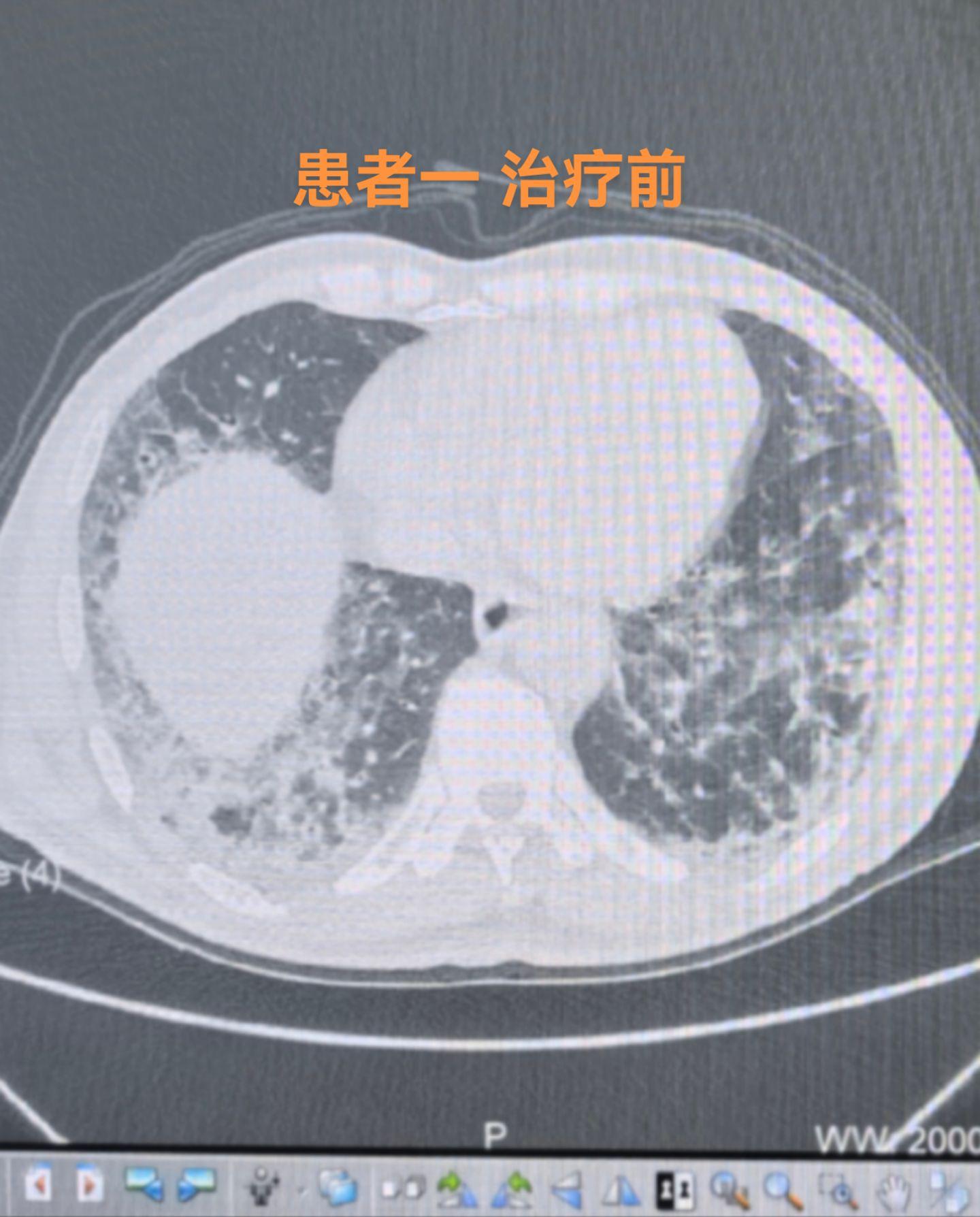 今天出院两位结缔组织病间质性肺炎的患者。合并