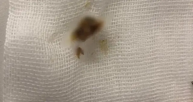 北晚新视觉网杭州姑娘一觉醒来听不见了!医生从她耳朵里挖出一大坨脏东西