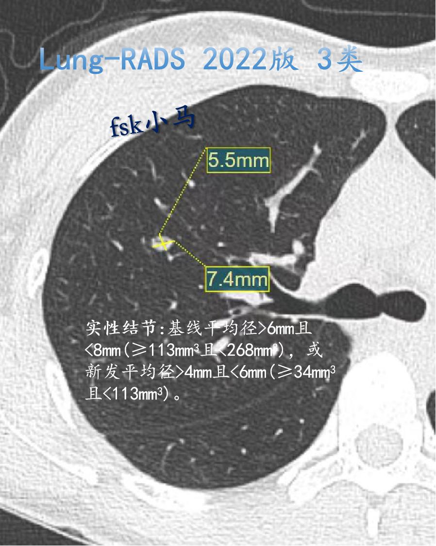 Lung-RADS 2022版 3类：可能良性，群体罹患率9%。表现...