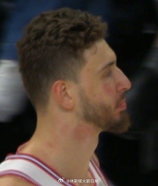 申京脸被打成这样，福斯特还能取消了戈贝尔的技术犯规，还说这只是个普通犯规火箭vs