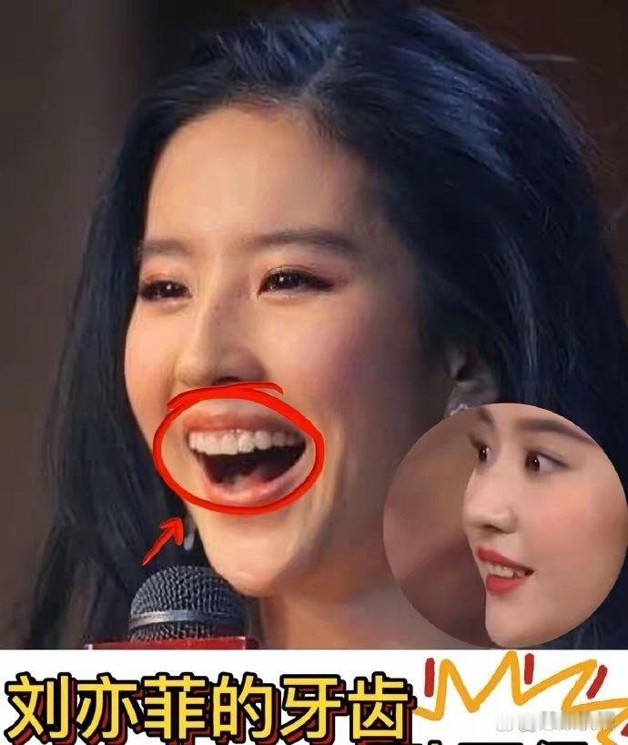 亦菲的牙齿怎么怪怪的，是深覆合吗 