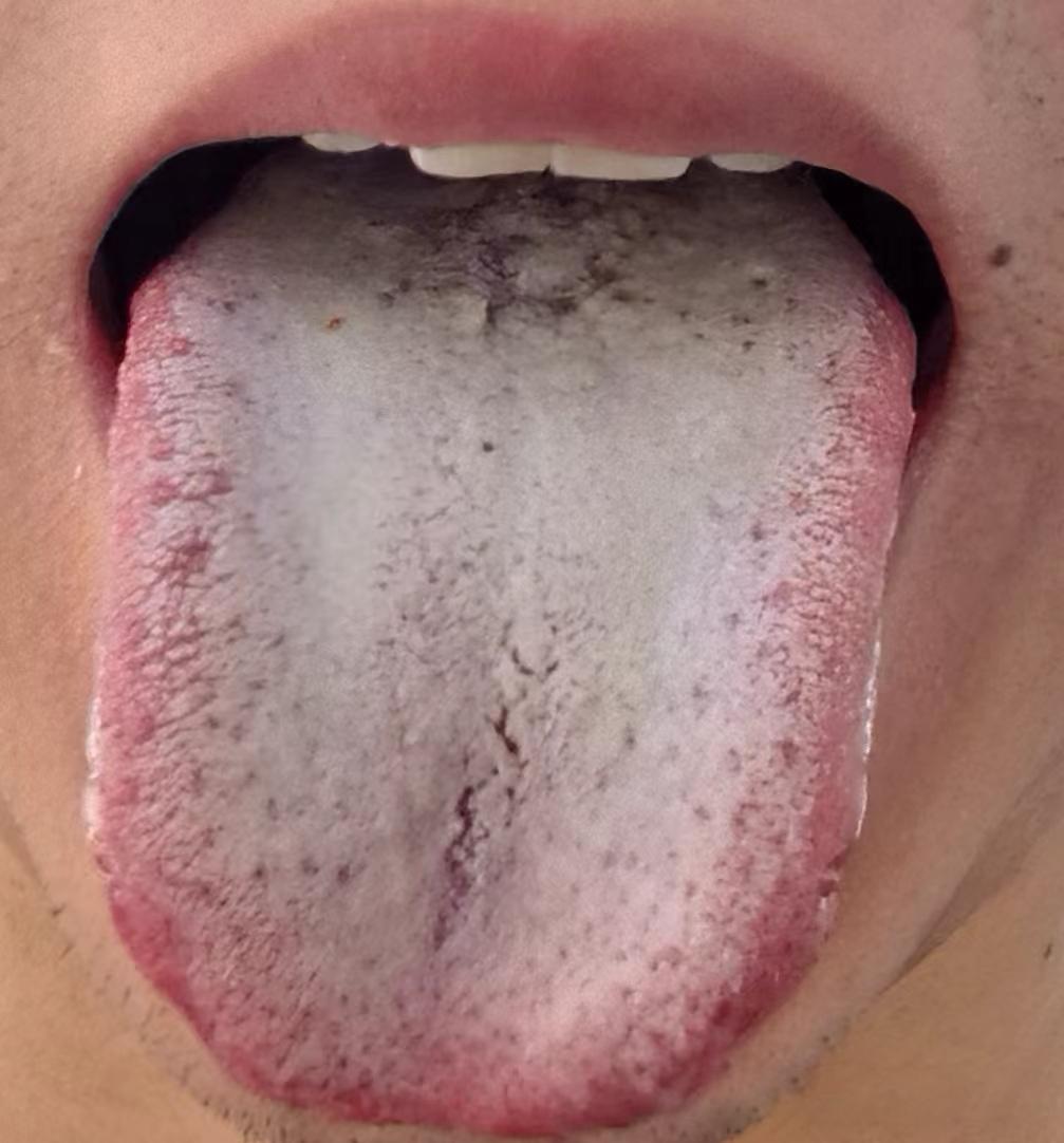 一位年轻小伙子，湿邪很重，大腿根总是湿乎乎的
舌头一层白腻苔，然后舌质却很红，寒