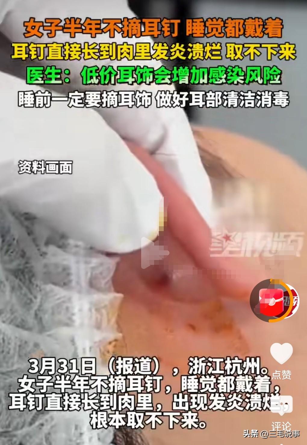 想不到戴耳钉的后果竟然是这么的严重啊！真是让人瑟瑟发抖啊。
3月31日报道，有一