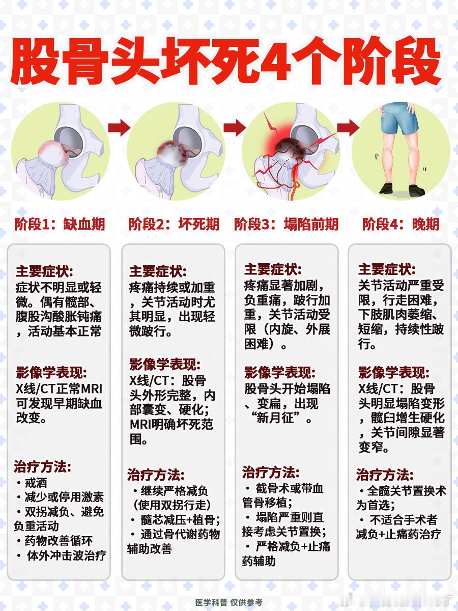股骨头坏死的4个阶段|||股骨头坏死按照Ficat分期分为4期，每期的症状和应对