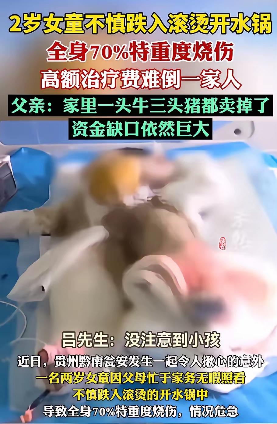 这口锅怕是忘不掉了。

贵州山里两岁女童跌进烫猪的开水锅，全身七成皮肤烫得发白。