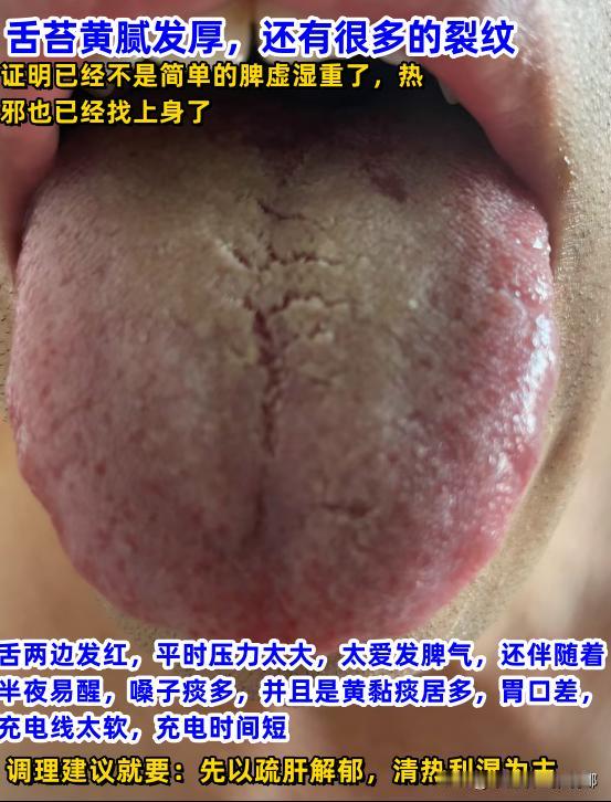 应粉丝要求，每天给大家分析舌象！
你来发，我lai看。
注意：
①拍摄正确拍照
