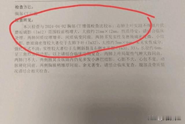 刘懿博士说肺癌（一二〇八二）磨玻璃影又不是结节怎么可能是肺癌