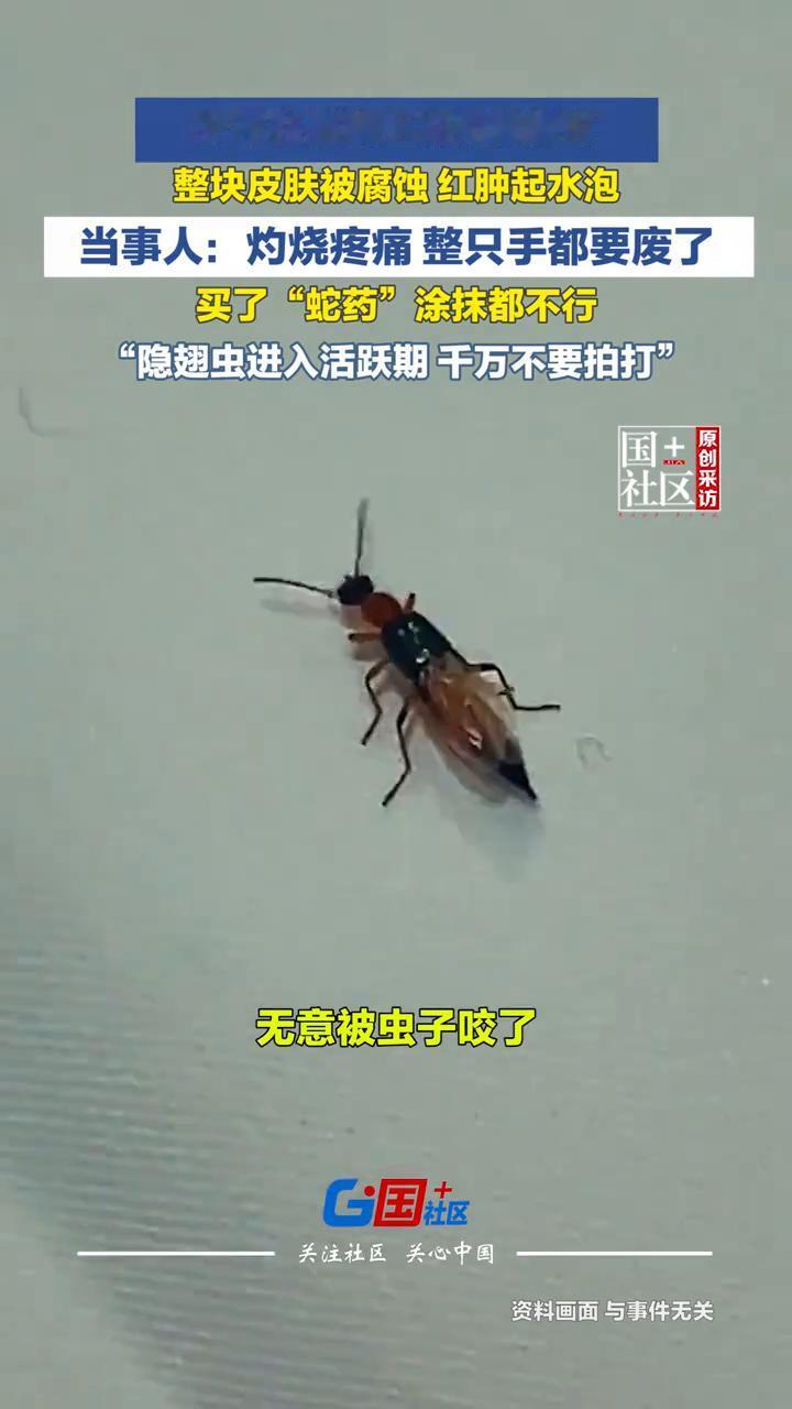 女子在手腕上拍死隐翅虫，整块皮肤被腐蚀红肿起水泡。当事人：灼烧疼痛整只手都要废了