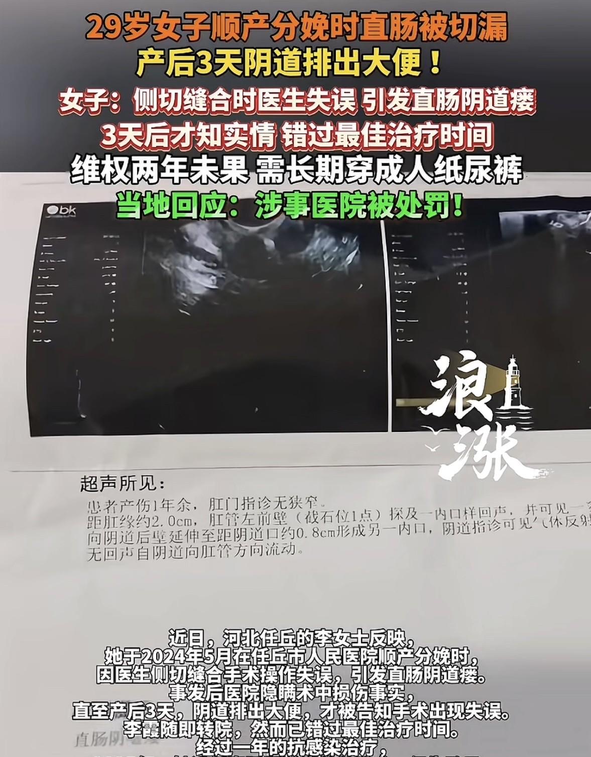 河北任丘，29岁女子顺产生娃，3天后从阴道里排出大便，女子懵了，赶紧去医院查看，