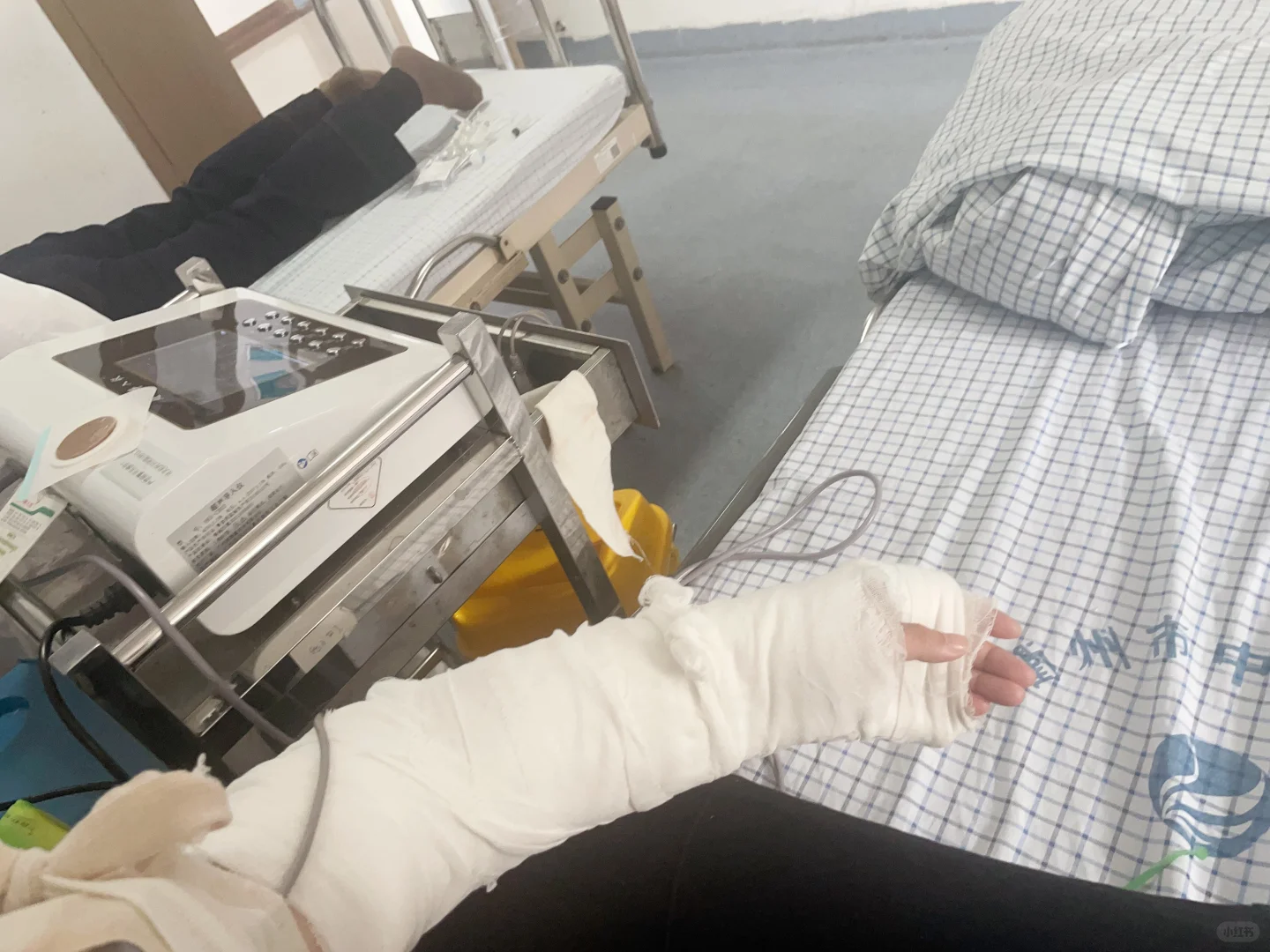 打石膏生活的第二天