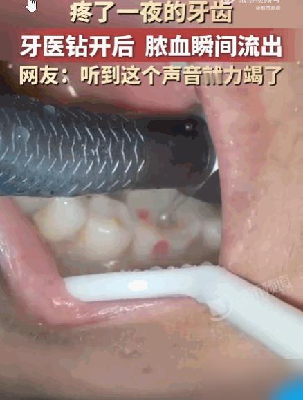 光看着都揪心！

我前年也栽过急性牙髓炎的坑，跟这个河南大哥的经历简直一模一样，