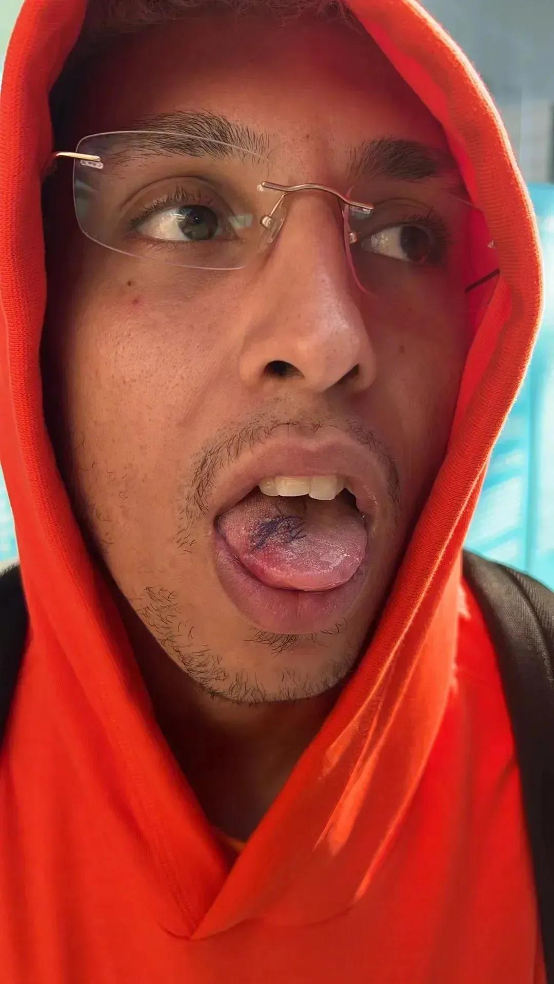 可怜的克雷桑，由于严重的舌伤，缝了6针，这两天进食只能以流食和常温食物为主，还要
