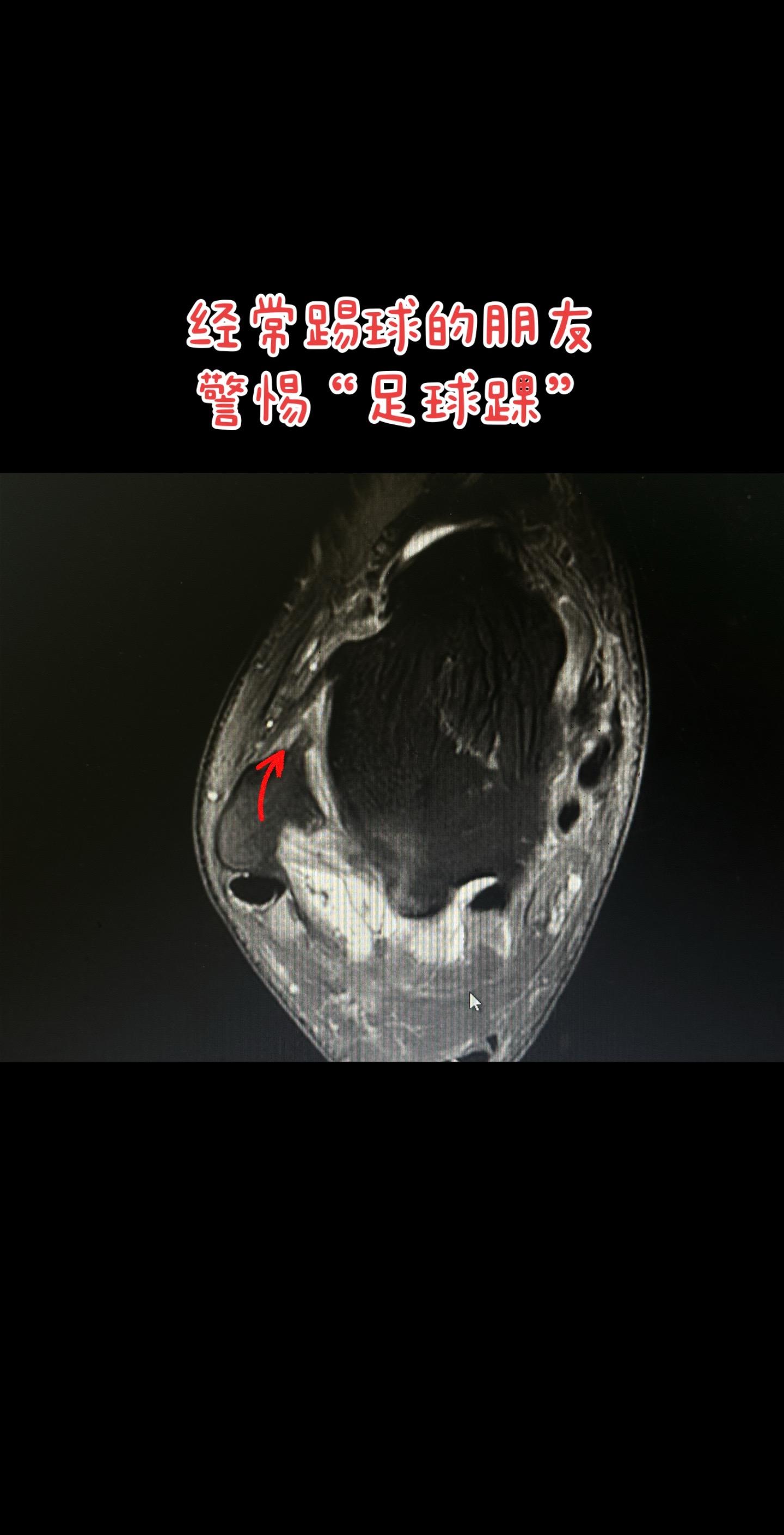 什么是足球踝呢。踢球的小伙伴要注意了