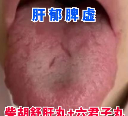柴胡疏肝丸这样搭配，不仅疏肝，还能健脾和胃，养出好身体

1、柴胡疏肝丸与六君子