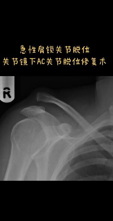 急性肩锁关节脱位。关节镜下肩锁关节脱位修复术