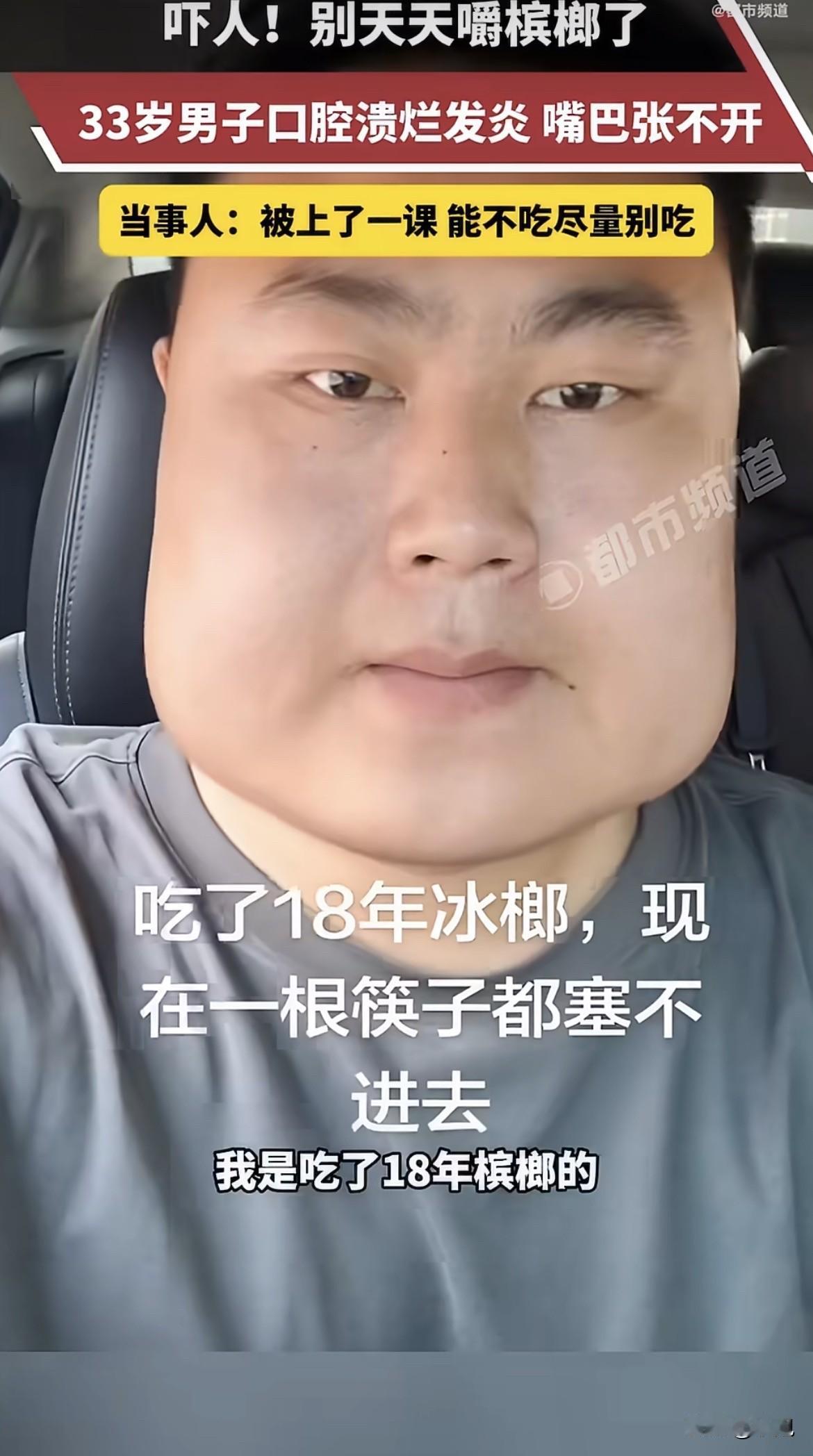 脸都能从尖的嚼成方的，这东西得多狠。
湖北33岁男的，15岁开始嚼槟榔，嚼了18