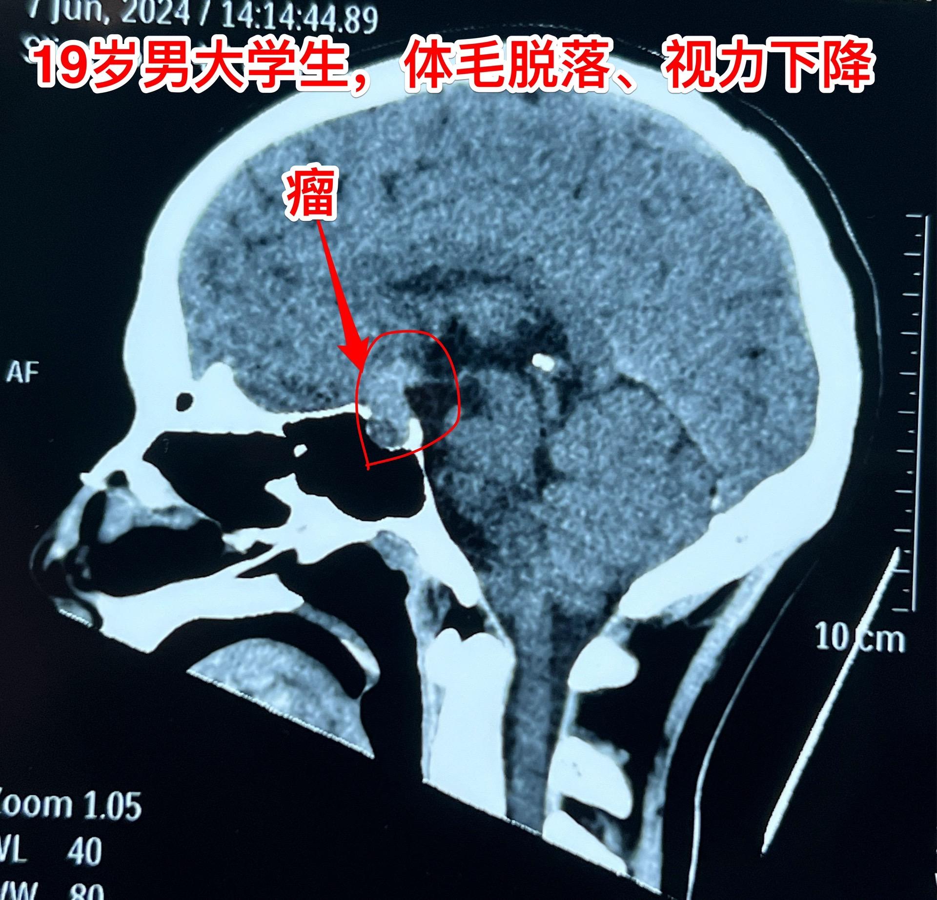 19岁重庆市的大学生发现自己体毛脱落！19岁重庆市的大学男生，发现自己...