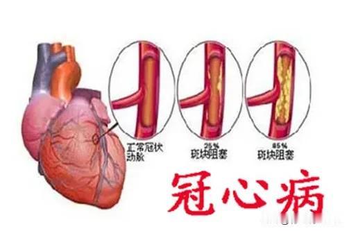 七大常用冠心病中成药，心脏不好的人赶紧收藏！早了解可救命！

随着生活节奏的加快