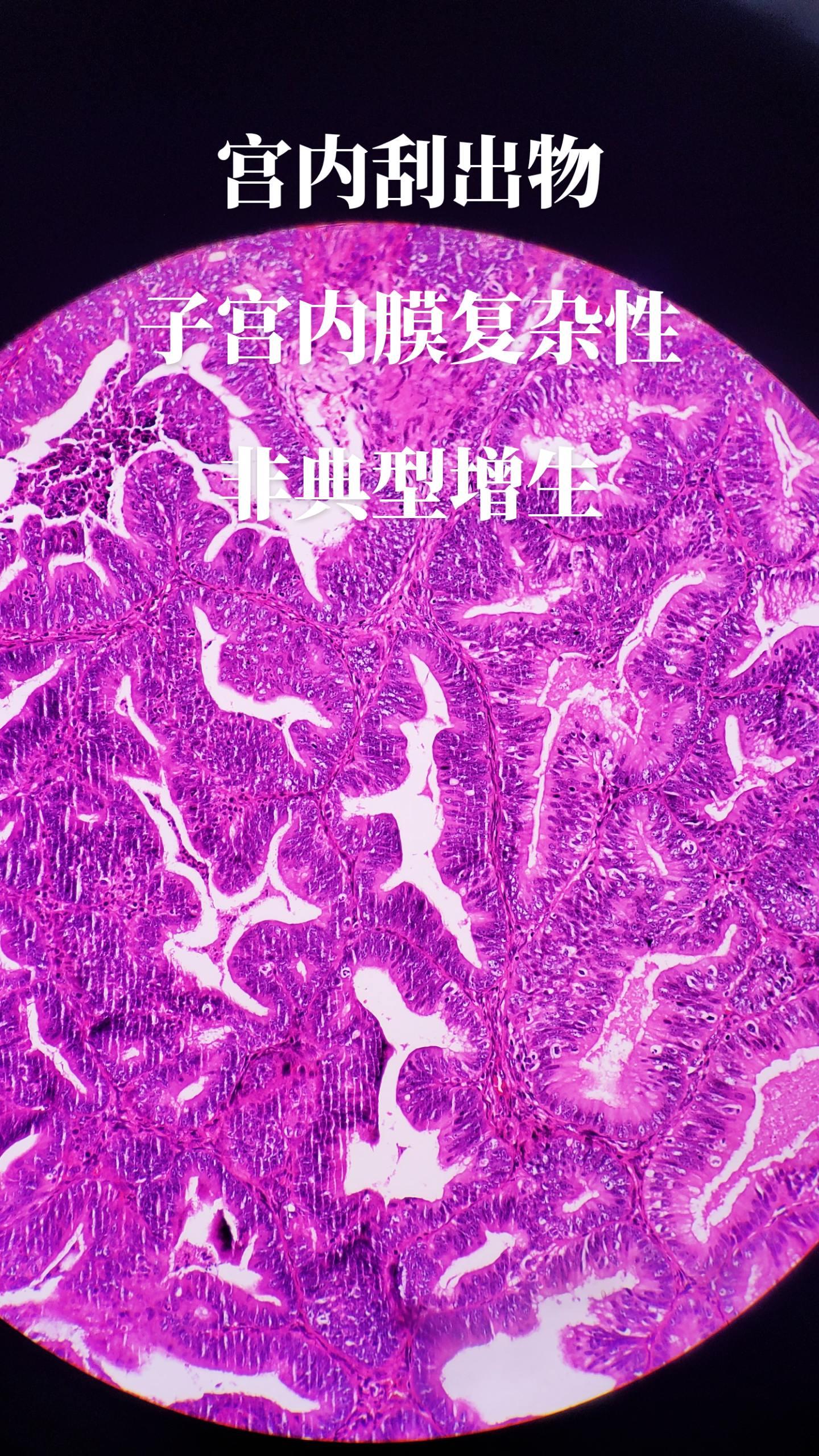 子宫内膜增生
