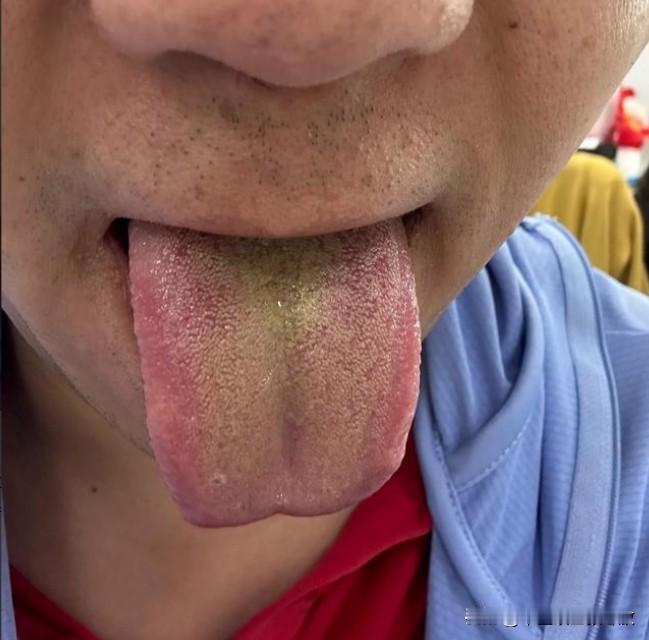 舌边鼓胀发红，舌根舌苔黄腻，那你男人的尊严可是真够呛[吃瓜群众][吃瓜群众][吃