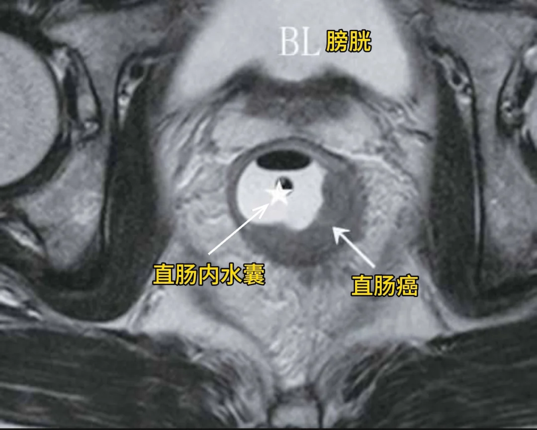 直肠癌的影像表现