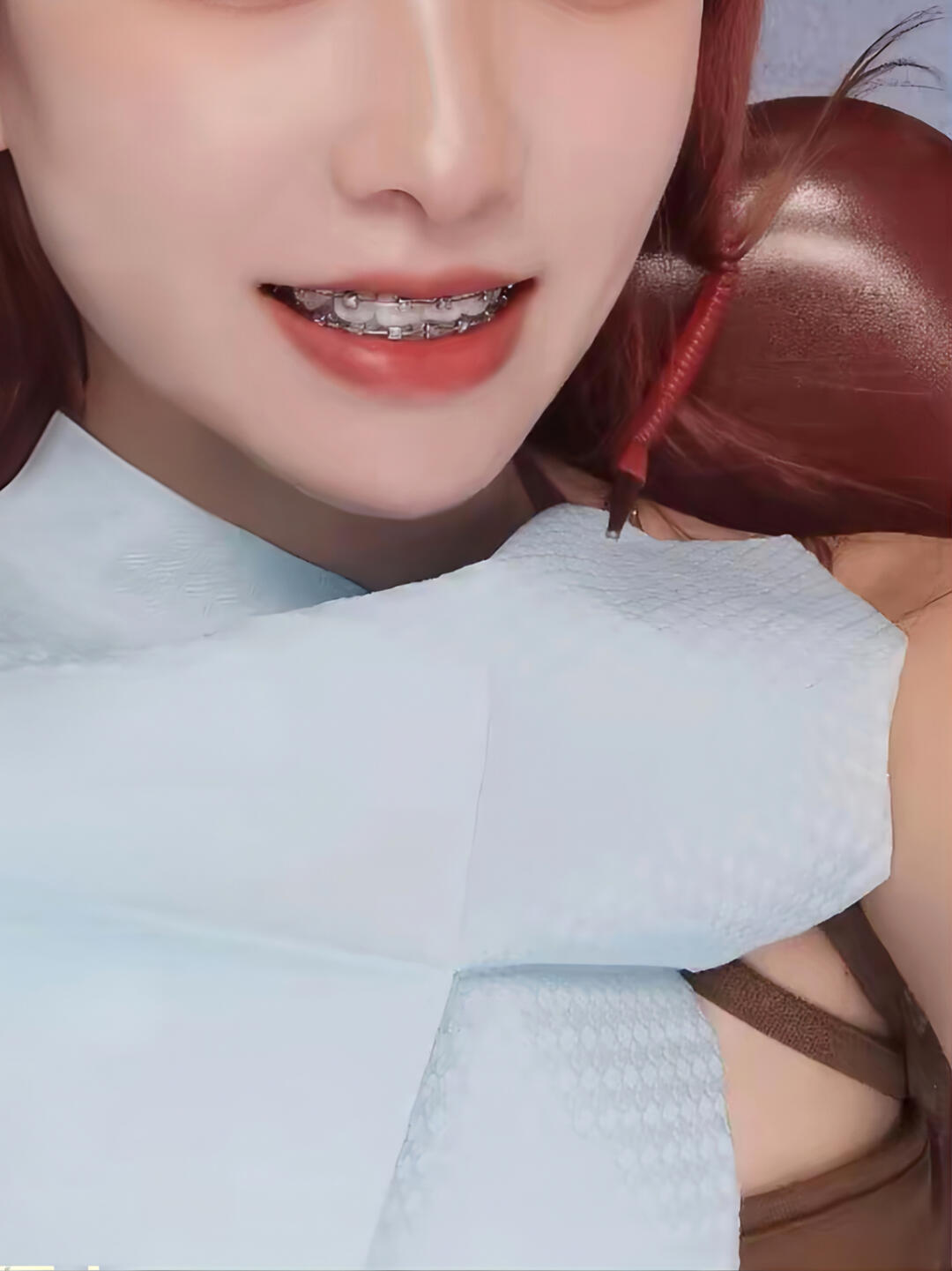 在北京正畸预算2w+戴上金属托槽，算值吧？