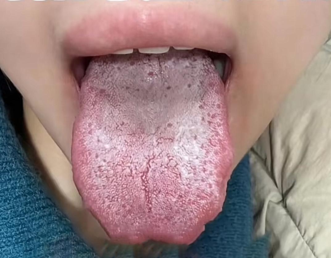 舌头又是红，舌苔又是白的，如果你也是这样的舌头，男科障碍可逃不掉了[灵光一闪][
